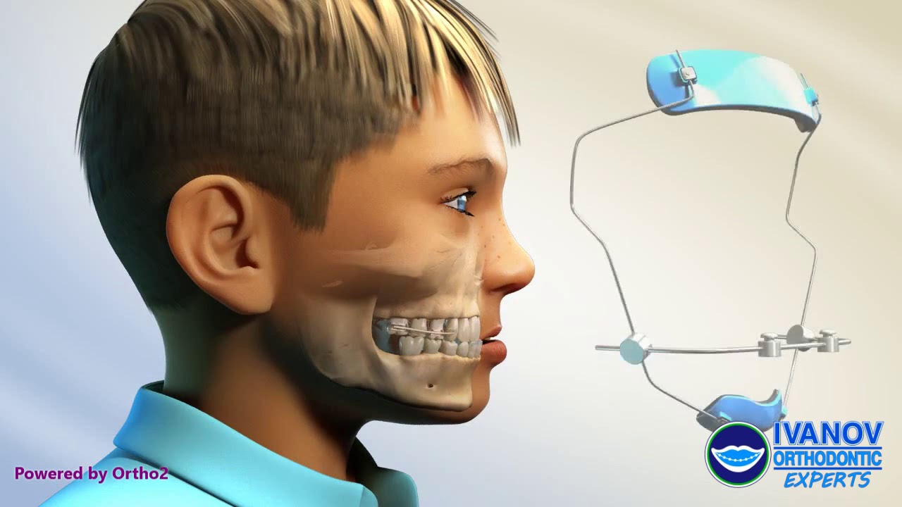 How To Take Care Of Clear Retainers After Braces?