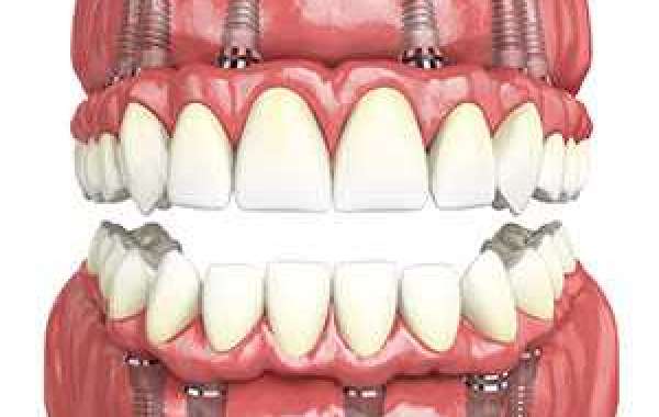 Benefits of Full Mouth Rehabilitation
