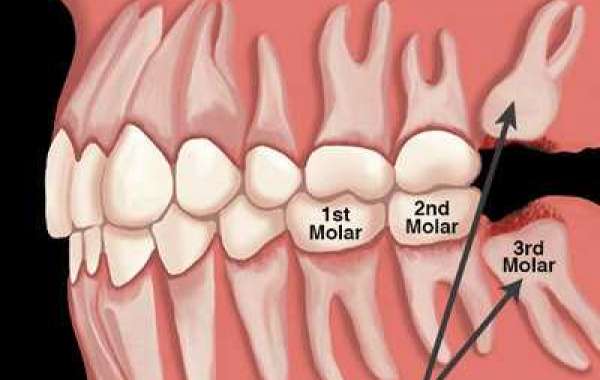 6 Things everyone should know about wisdom tooth removal