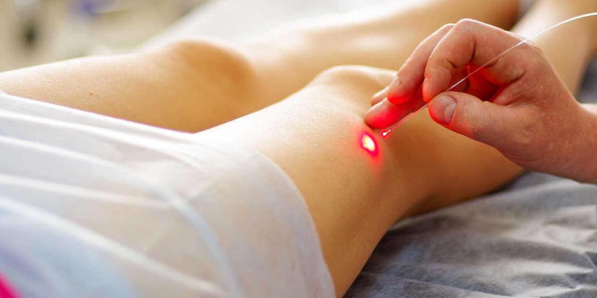 Laser Vein Treatment