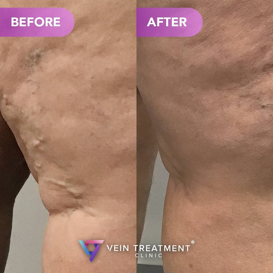 Vein Treatment Doctor