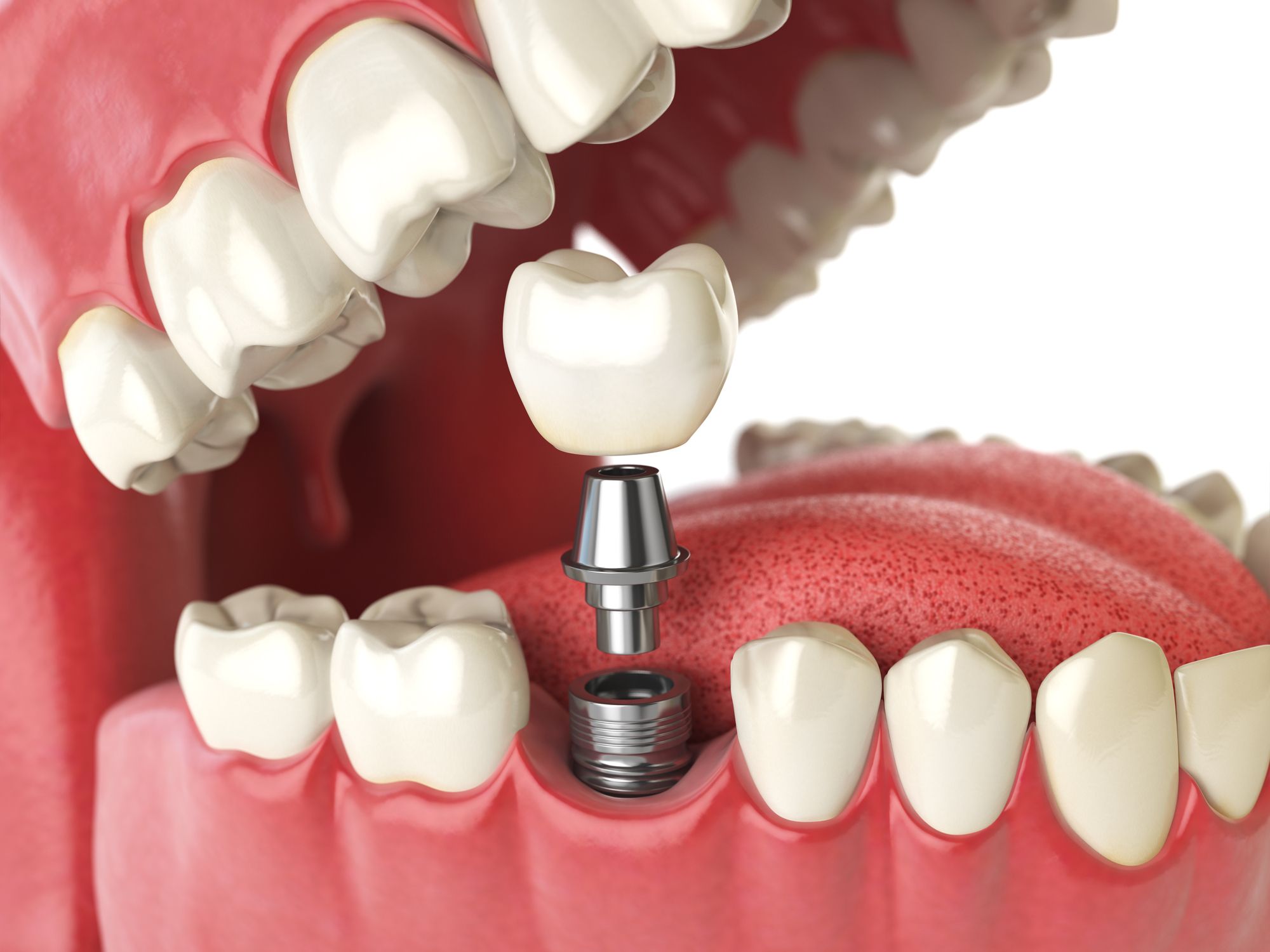 Is a Dental Bridge the right treatment for missing teeth?